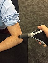 Extracorporeal shock wave therapy (ESWT) being administered to the arm. ESWT for lateral epicondylitis.jpg