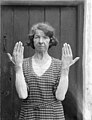 Female Pellagra sufferer - photo by Dr JC Walsh, Clonmel, Ireland - 1937 (6034320029).jpg