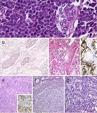 Histopathology of carcinoma of the thyroid with Ewing family tumor elements, and intrathyroid thymic carcinoma.jpg
