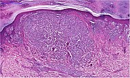 Histopatologie invazivního akrálního lentiginózního melanomu.jpg