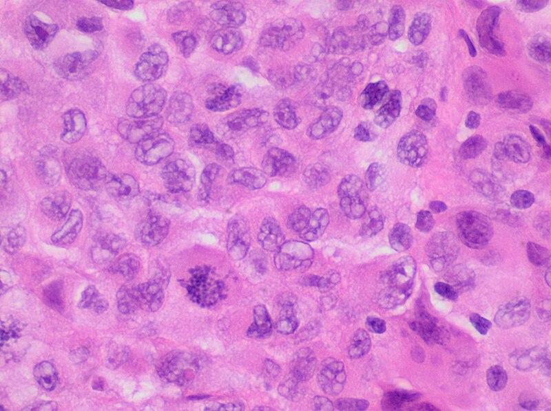 File:Histopathology of undifferentiated tumor cells.jpg