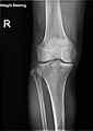 Knee plain X-ray weight bearing.jpg