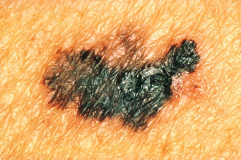 File:Melanoma1.jpg