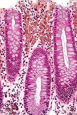 Miniatura para Melanosis coli