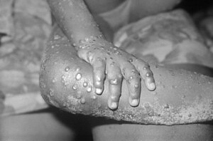 A rash caused by mpox