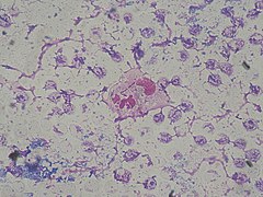 pseudomonas aeruginosa burn infection