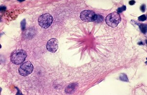 Sarcoidosis - Asteroid body