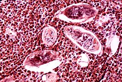 Schistosomiasis haematobia.jpg