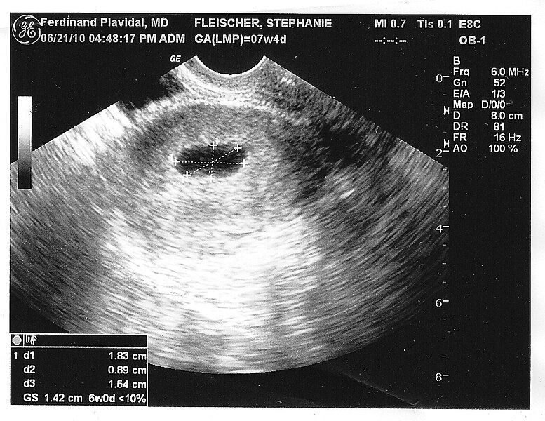 File:Ultrasound (5323399689).jpg