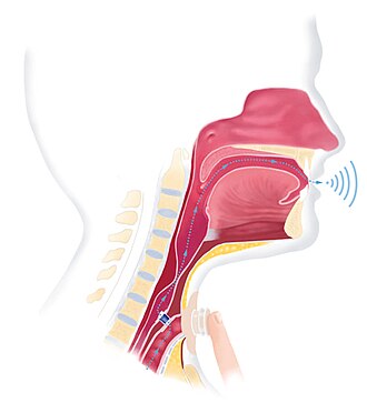 Voice prosthesis Voice prosthesis.jpg