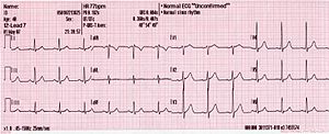 Frecuencia Cardíaca: Número de contraccións do corazón ou pulsacións por unidade de tempo