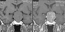 Magnetic resonance image of a pituitary macroadenoma that caused acromegaly with compression of the optic chiasm Acromegaly pituitary macroadenoma.JPEG