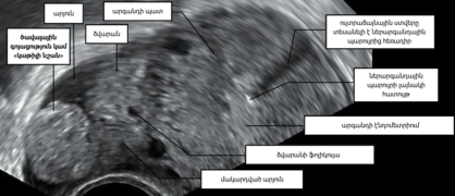 Արտարգանդային հղիության ժամանակ հեշտոցային ուլտրաձայնային հետազոտությամբ տեսանելի կաթիլի նշան: