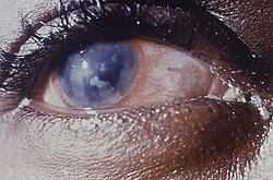Congenital syphilis cataract