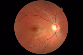 Fundus photograph of a healthy right eye (OD) from a myopic female Asian patient. Age 22