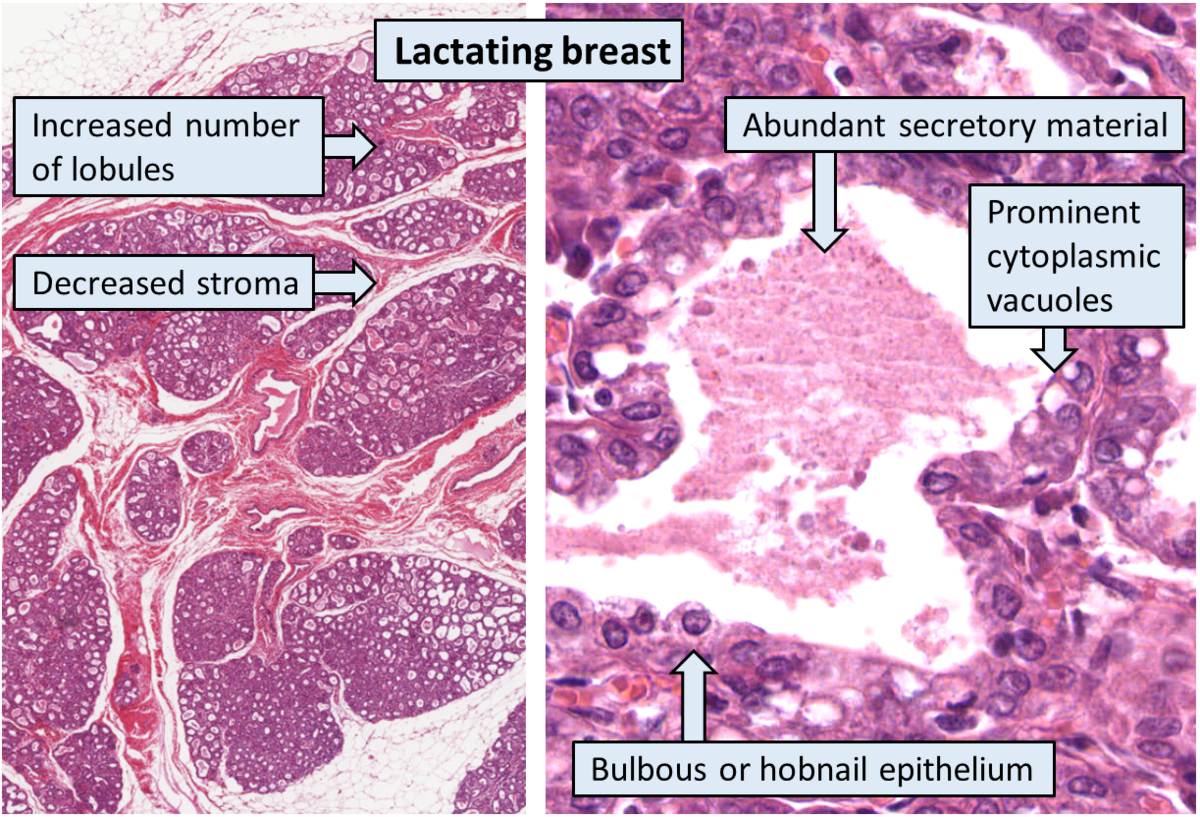 Mammoplasia - Wikipedia