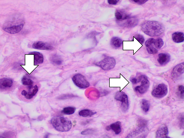 Acute inflammation characterised by neutrophils