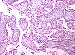 Thumbnail for File:Histopathology of chorionic villi at gestational age of 9 weeks.jpg