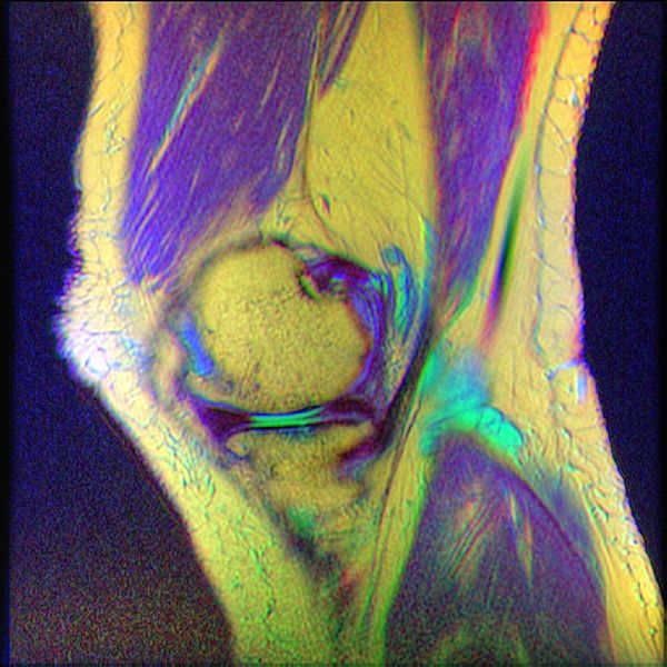 File:Knee MRI, T1T2PD 17.jpg