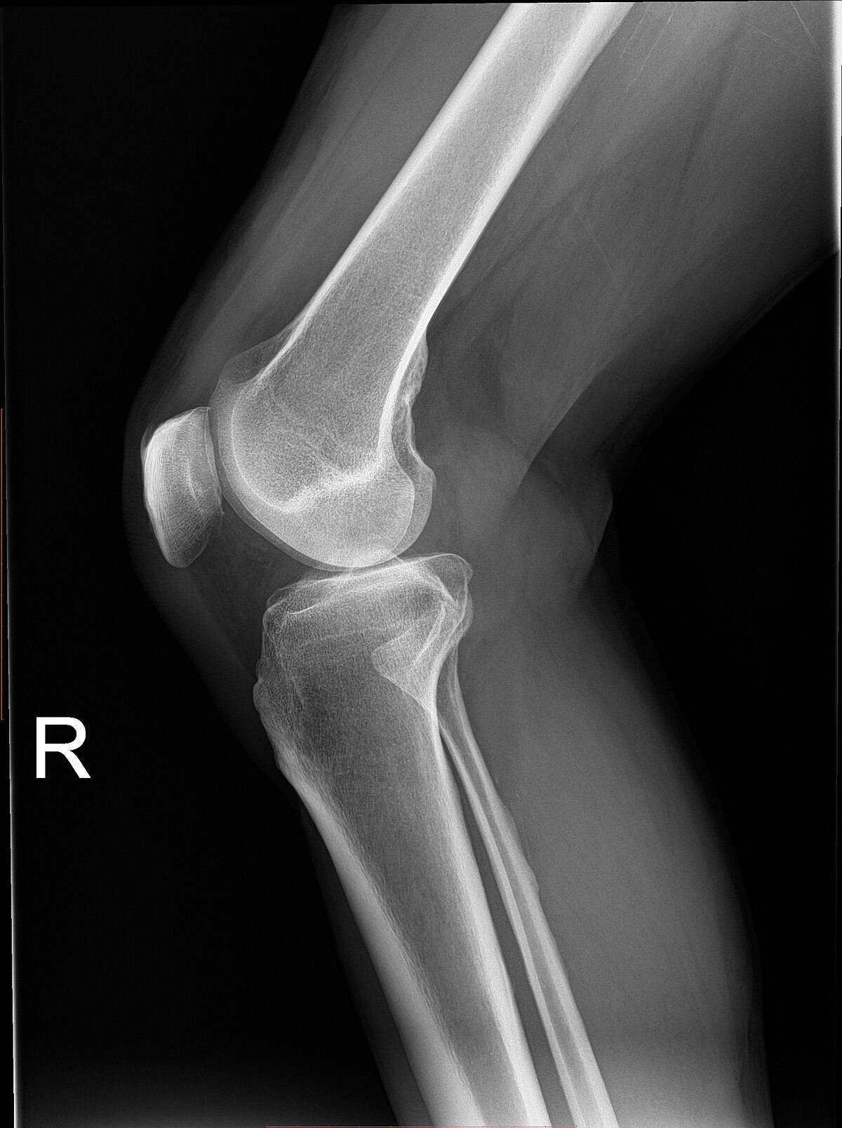 Knee plain X-ray.jpg