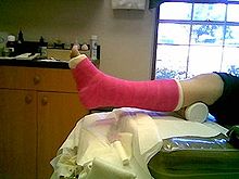 Orthopedic cast - Wikipedia