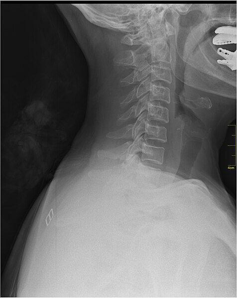 File:Medical X-Ray imaging UFQ07 nevit.jpg