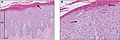 Psoriasis, histologisch: typische Akanthose mit ausgezogenen Retezapfen