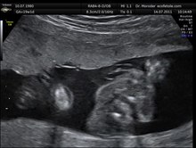 File: Urinating male fetus Dr.  Wolfgang Moroder.theora.ogv