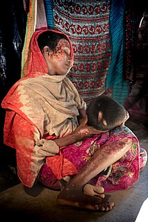 Rohingya woman, covered in bruises and burns; Tatmadaw troops dragged her into a house, raped her, and attempted to burn the house down whilst locking her inside. 0G2A6012.jpg