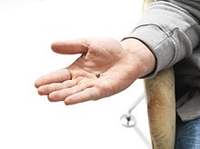 An implant shown in actual size in adult hand Baha implant in hand.jpg