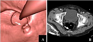 CT colonography of a rectal mass.jpg