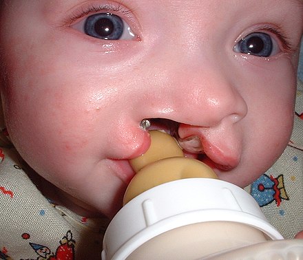 A baby being fed using a custom bottle