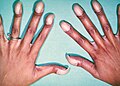 Paličkovité prsty u pacienta s Fallotovou tetralogií