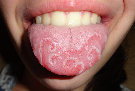 Many conditions, such as this case of geographic tongue, can be diagnosed partly on gross examination, but may be confirmed with tissue pathology.