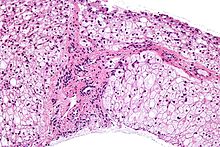 Micrograph of glycogen storage disease with histologic features consistent with Cori disease. Liver biopsy. H&E stain. Glycogen storage disease in liver - high mag.jpg