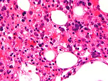 rák familiáris hemophagocytás lymphohistiocytosisban