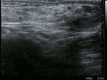 Ultrasound image of inguinal hernia. Moving intestines in inguinal canal with respiration. Inguinal hernia ultrasound 0530162612390 8M.gif