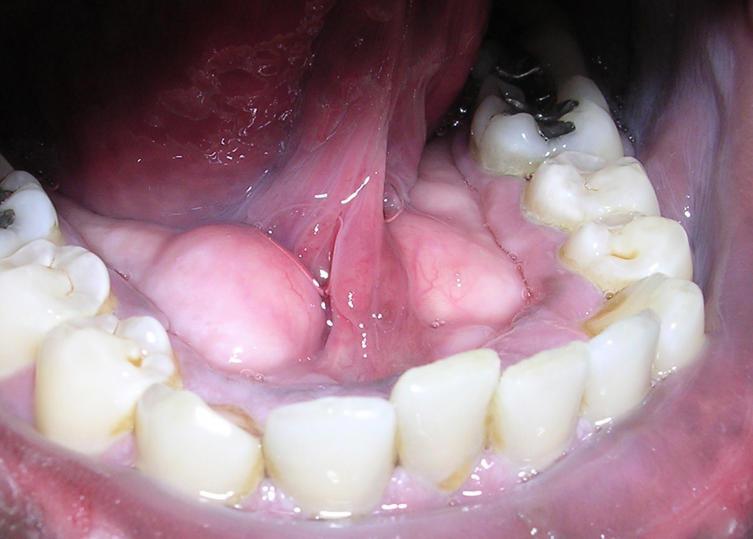 Cisto Linfoepitelial Oral - Patologia Bucal