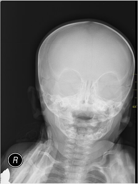 File:Medical X-Ray imaging TBE07 nevit.jpg