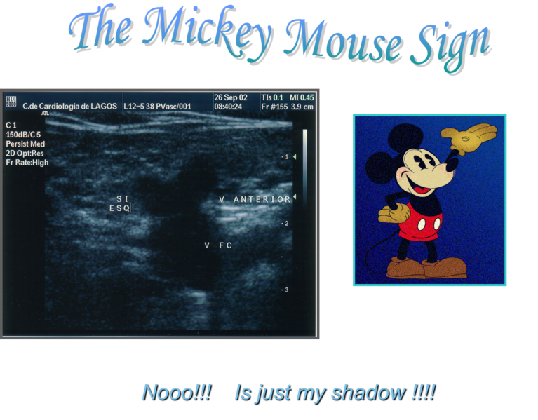 File:Mickey mouse sign.png