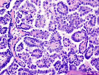 <span class="mw-page-title-main">Papillary serous cystadenocarcinoma</span> Medical condition