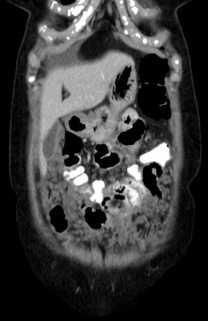 Mesotheliom: Formen, Einteilung, Ursache