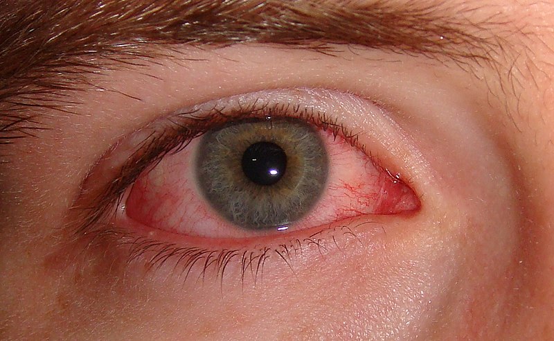 File:Pink eye.jpg