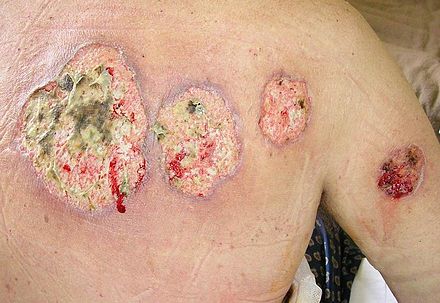 Pyoderma gangrenosum with large ulcerations affecting the back.