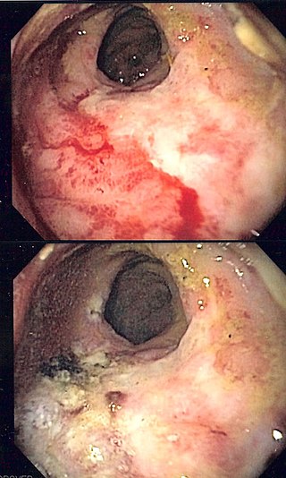 <span class="mw-page-title-main">Radiation proctitis</span> Medical condition