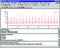 Thumbnail for Automated ECG interpretation