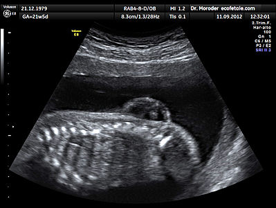 Ultrasound image of the spine at 21 weeks of pregnancy in a fetus affected by open spina bifida. Longitudinal scan with evident lumbar myelomeningocele.