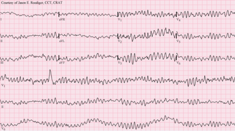 Fibrillation ventriculaire