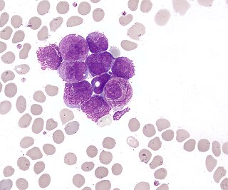 <span class="mw-page-title-main">Acute promyelocytic leukemia</span> Subtype of acute myeloid leukaemia characterised by accumulation of promyelocytes