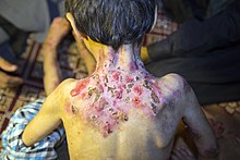 بیماری پروانه ای یا بیماری ای بی در کودکان مناطق محروم جنوب کرمان- ایران 11.jpg